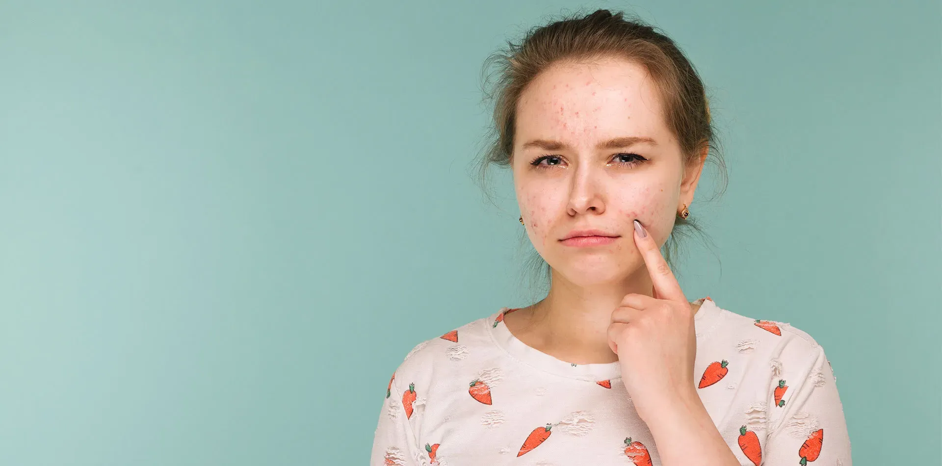 Acne Scars – All You Need to Know